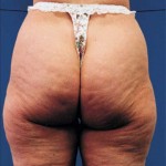 cellulite