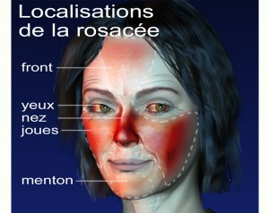 rosacée ou couperose