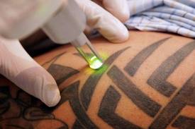 Se faire détatouer
