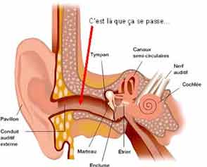 une otite externe est une inflammation ou une infection du conduit de l'oreille