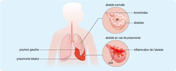 Pneumonie aiguë frontale
