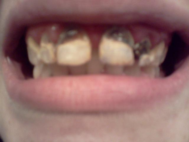 Pourquoi Se Laver Les Dents