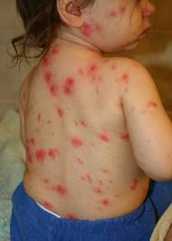 Soulager les démangeaisons de la varicelle avec les huiles essentielles